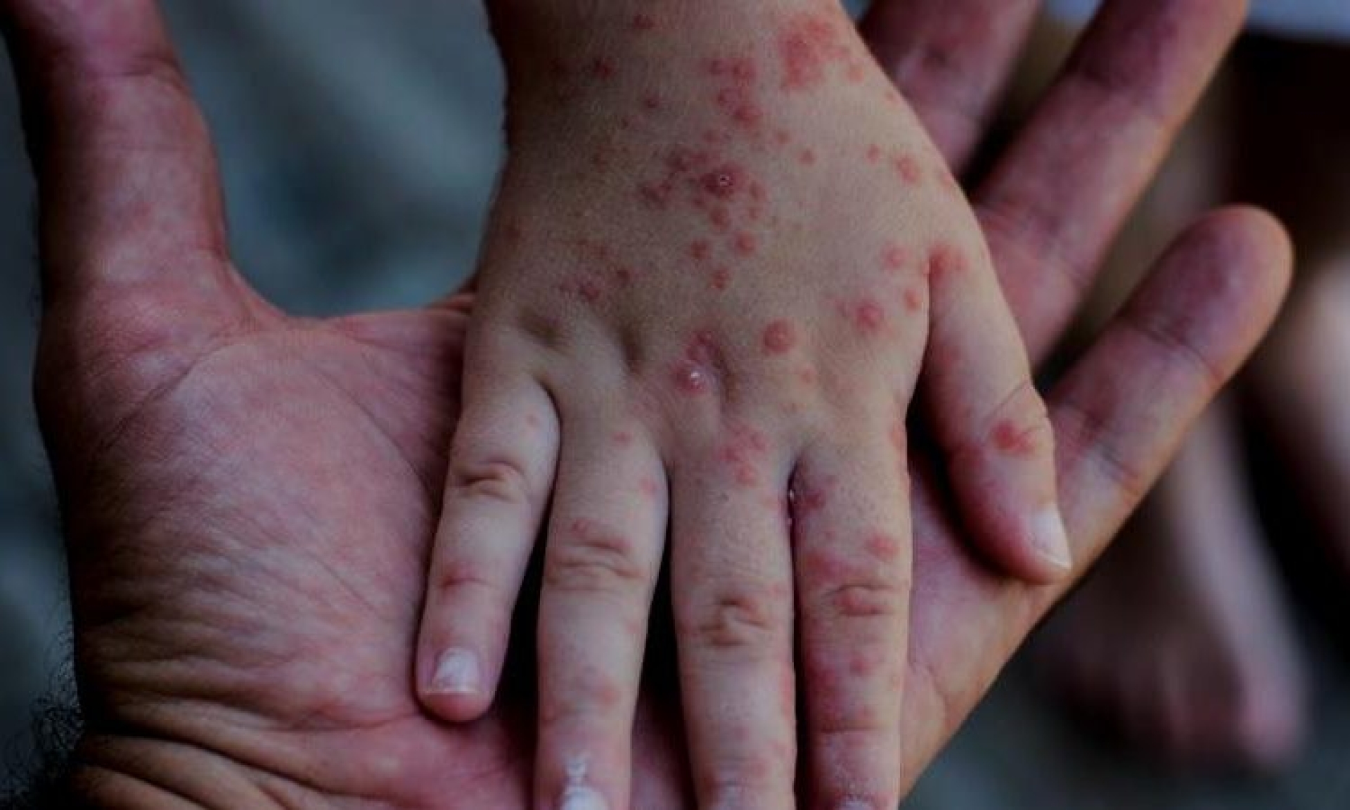 La OMS alerta por incremento 'alarmante' de casos de sarampión
