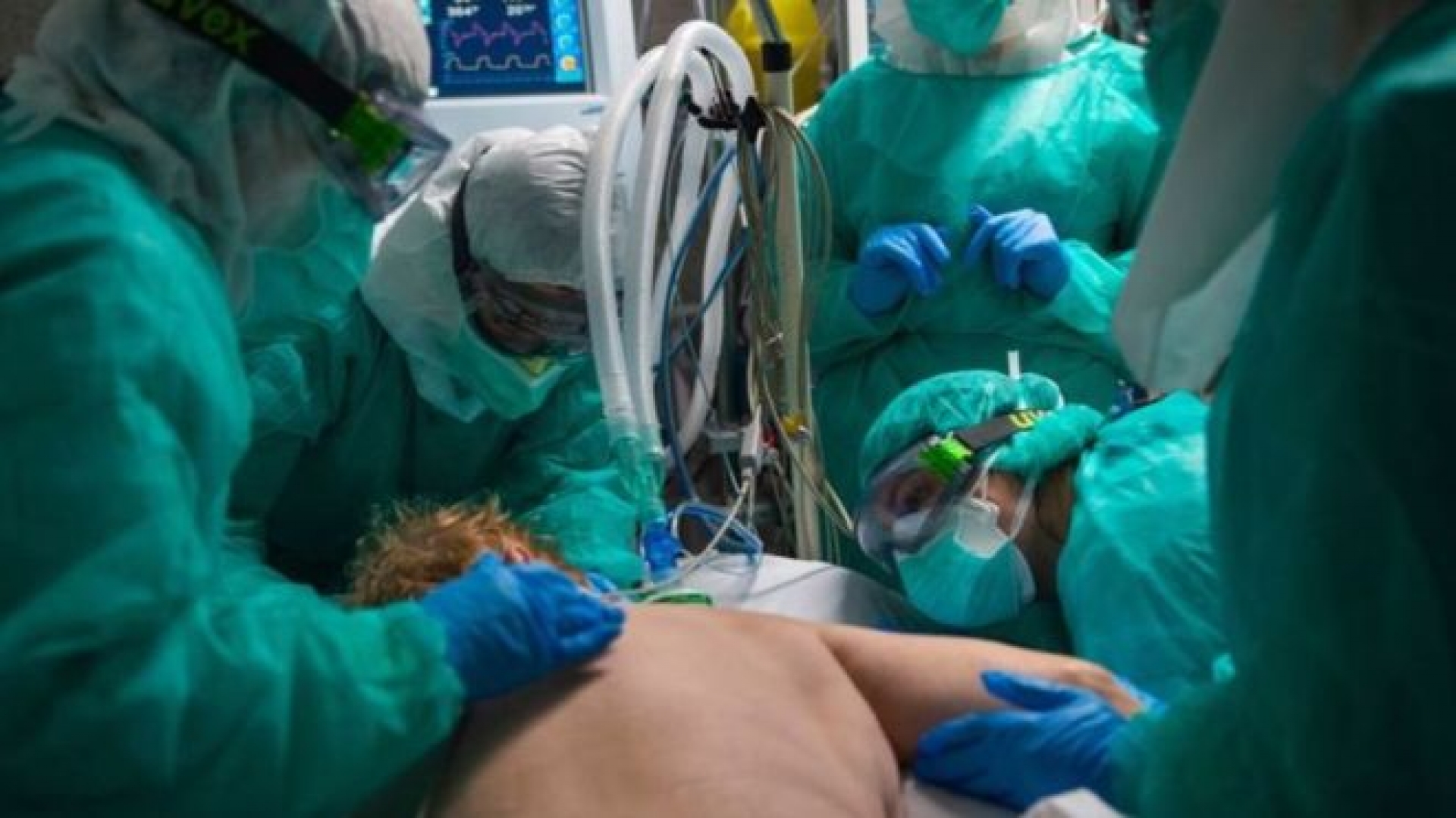 ¿Por qué la técnica de acostar a los pacientes boca abajo les está salvando la vida a muchos enfermos de covid-19?