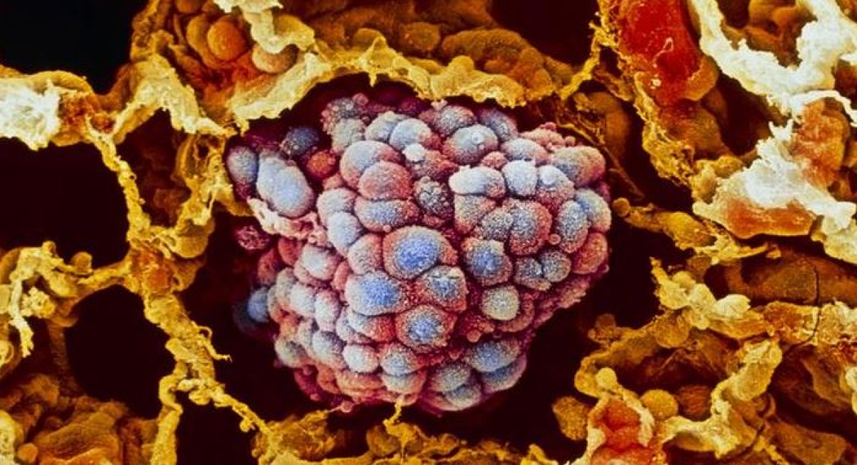 El 90% de genes humanos estudiados se menciona en investigaciones sobre el cáncer