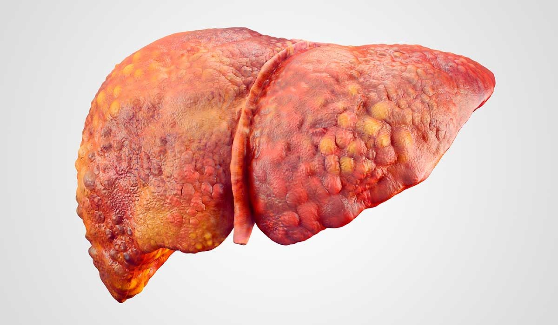 A la baja, casos de hepatitis en Morelos: SSM