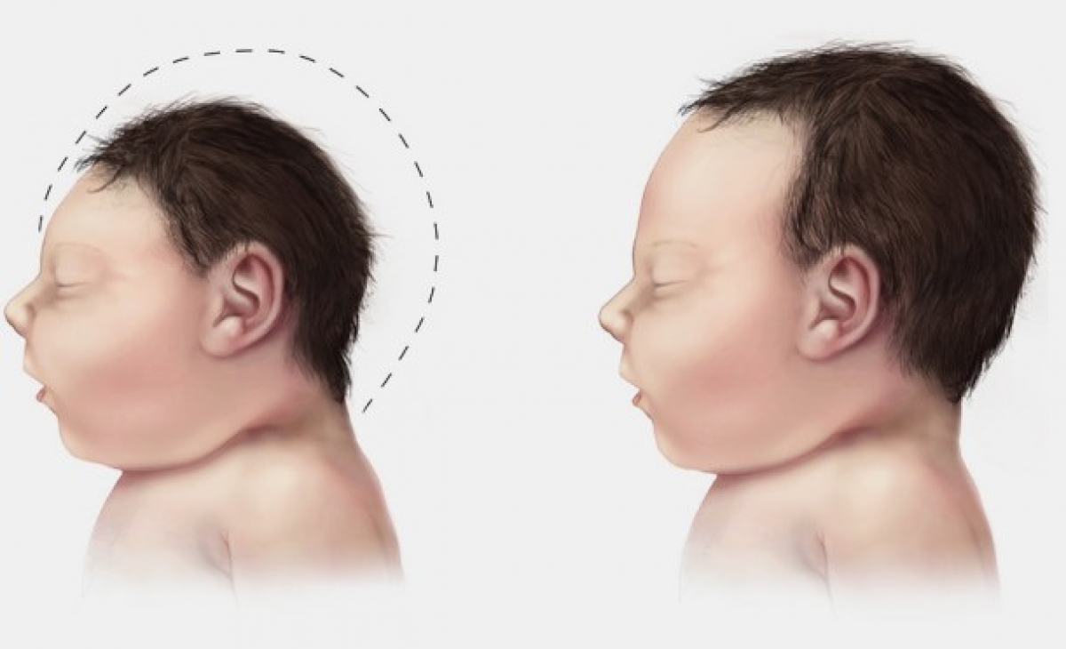 Nace en Barcelona el primer bebé español con microcefalia por el virus zika