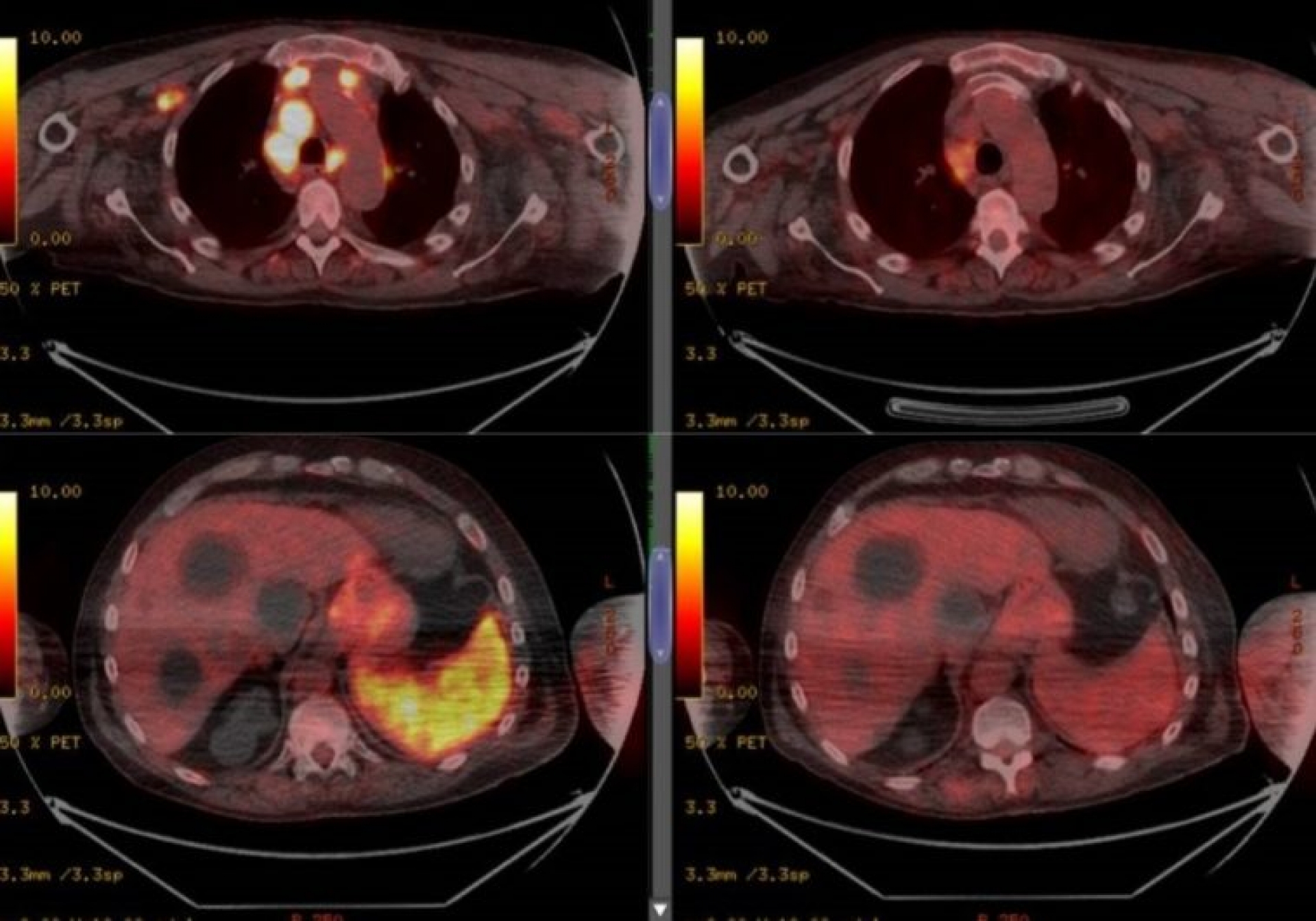 Hombre se curó de cáncer después de tener COVID-19, ya investigan el caso