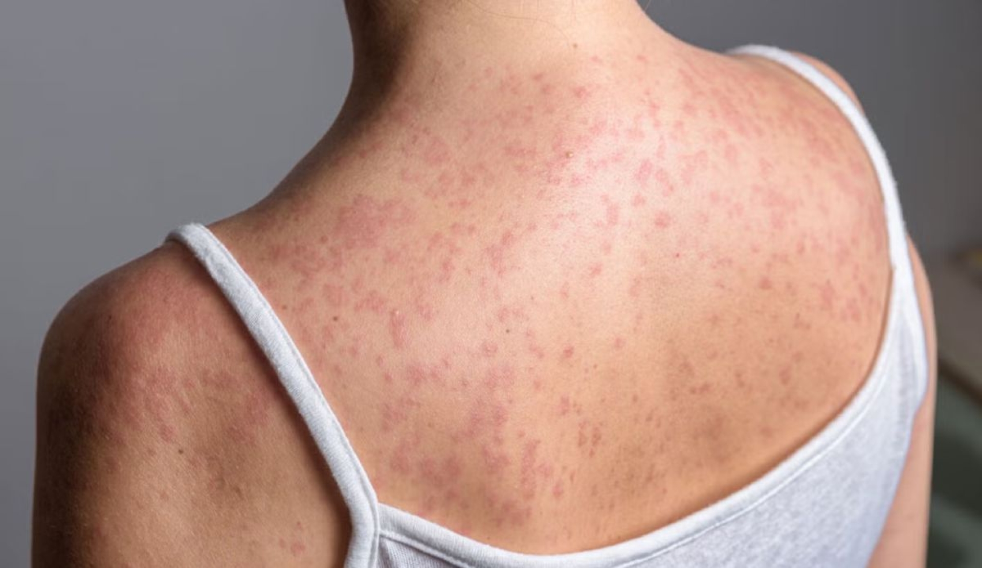 Cómo identificar el sarampión y prevenir su contagio de forma segura