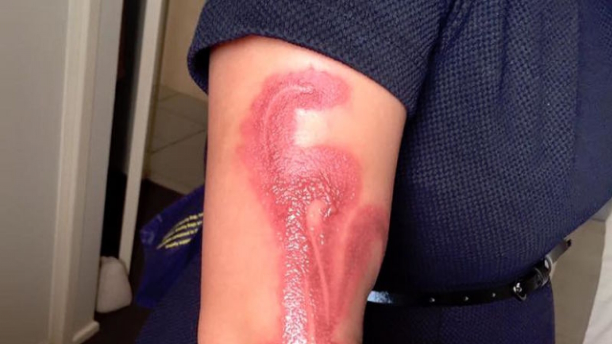 Se queda dormida con su iPhone 7 y se quema el brazo