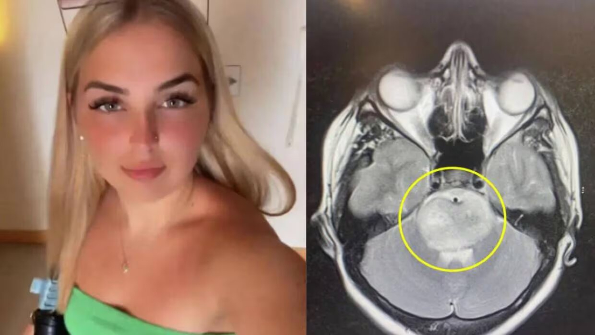 'Me quedan 12 meses de vida': Joven confunde resaca con enfermedad terminal