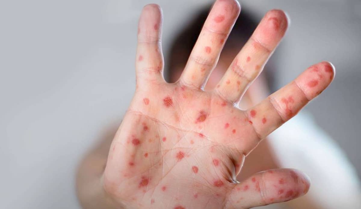 Contabilizan 22 casos de viruela símica en Morelos