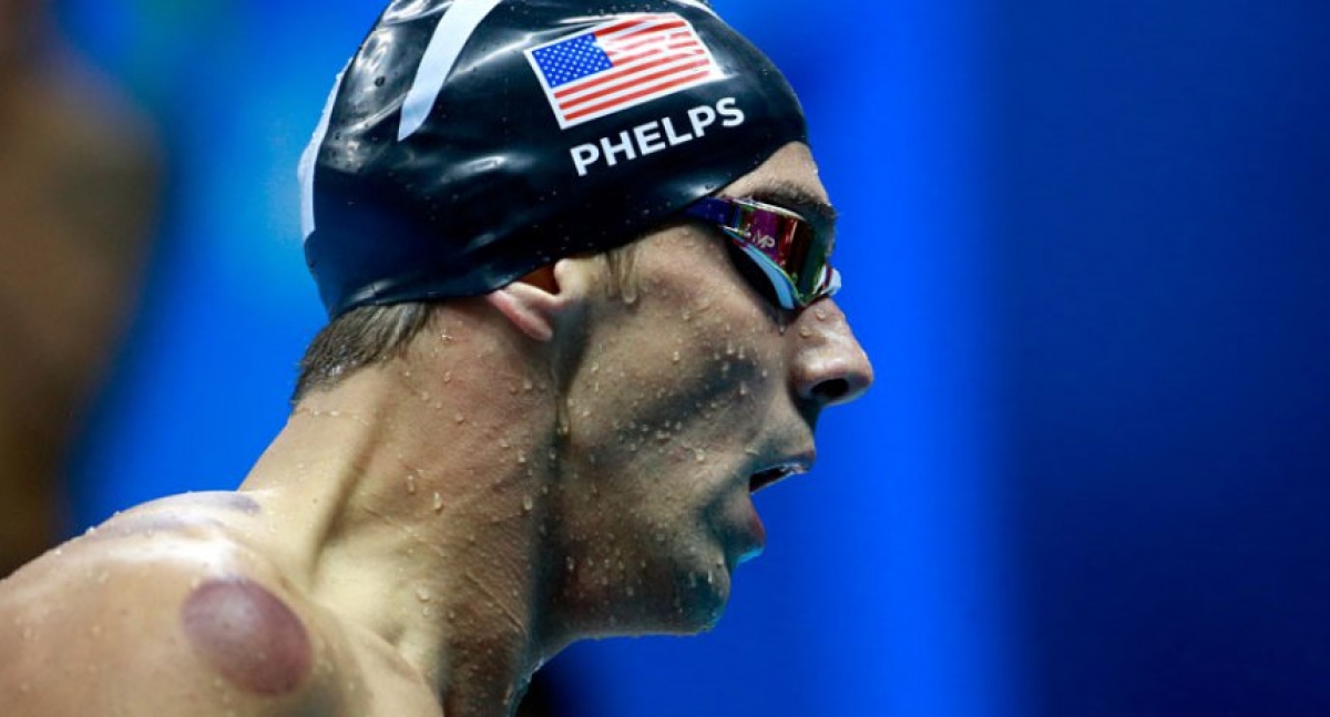 ¿Por qué el cuerpo de Michael Phelps está lleno de manchas?