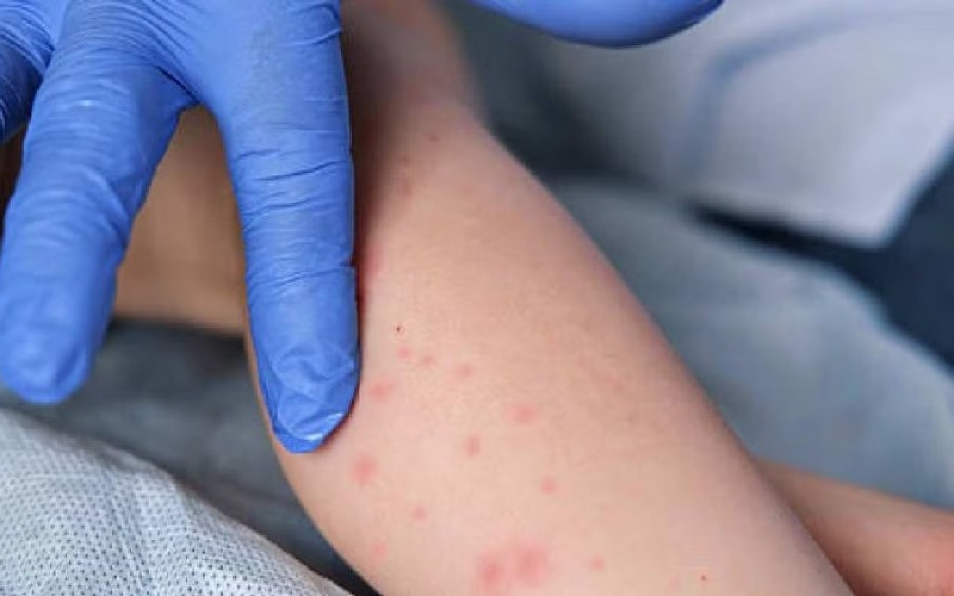 México en riesgo de perder certificación de país libre de sarampión