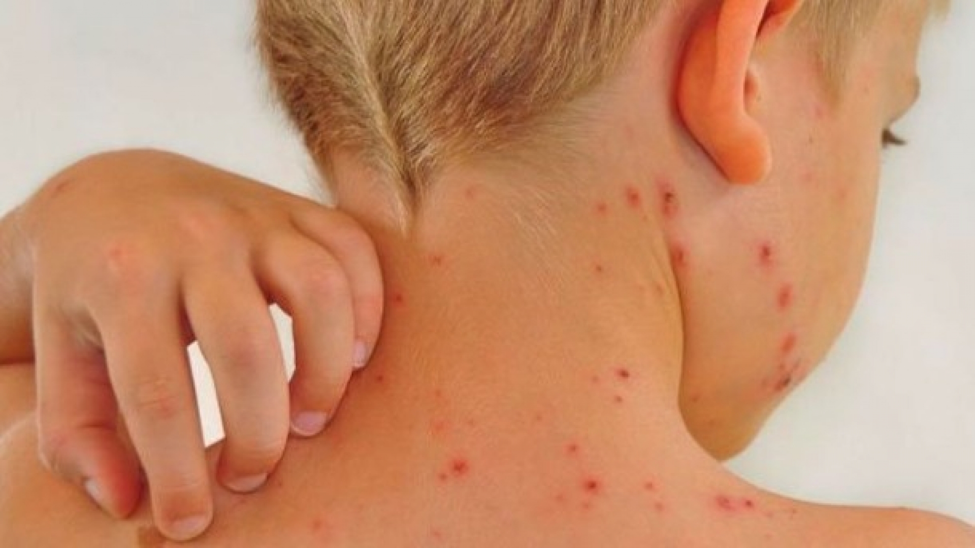 Llaman a prevenir varicela