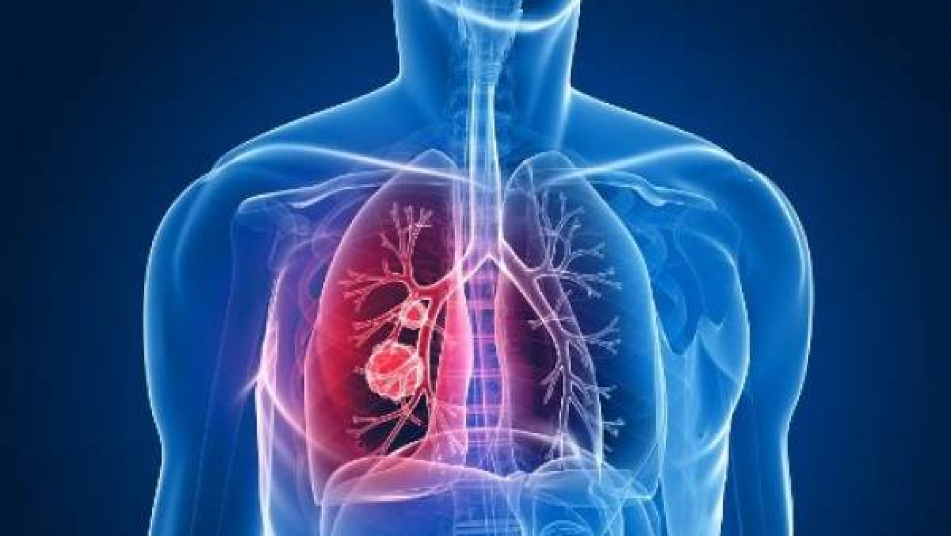 Anuncian gran estudio para detectar a tiempo el cáncer de pulmón