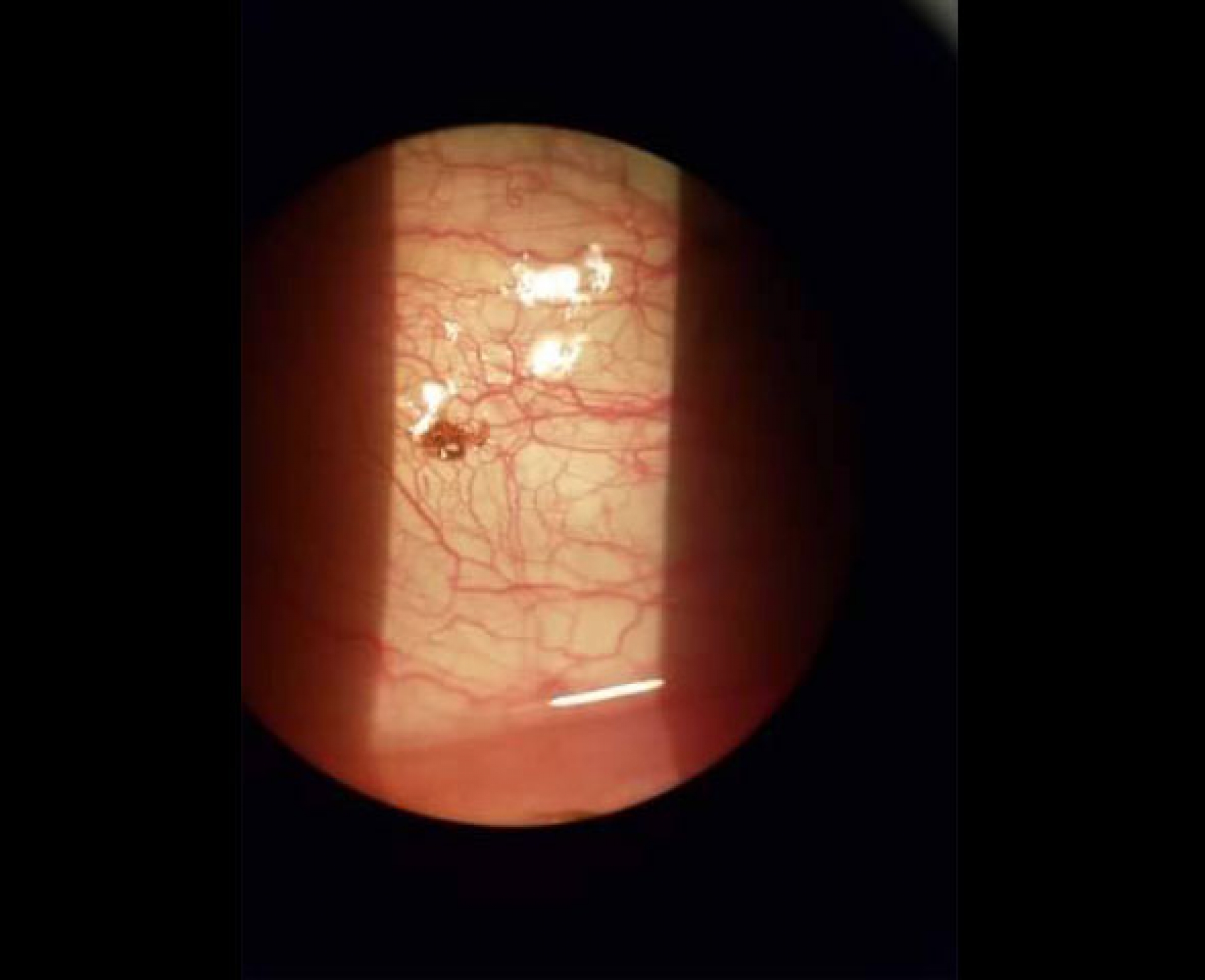 Acude al médico por un ojo irritado; tenía una garrapata incrustada