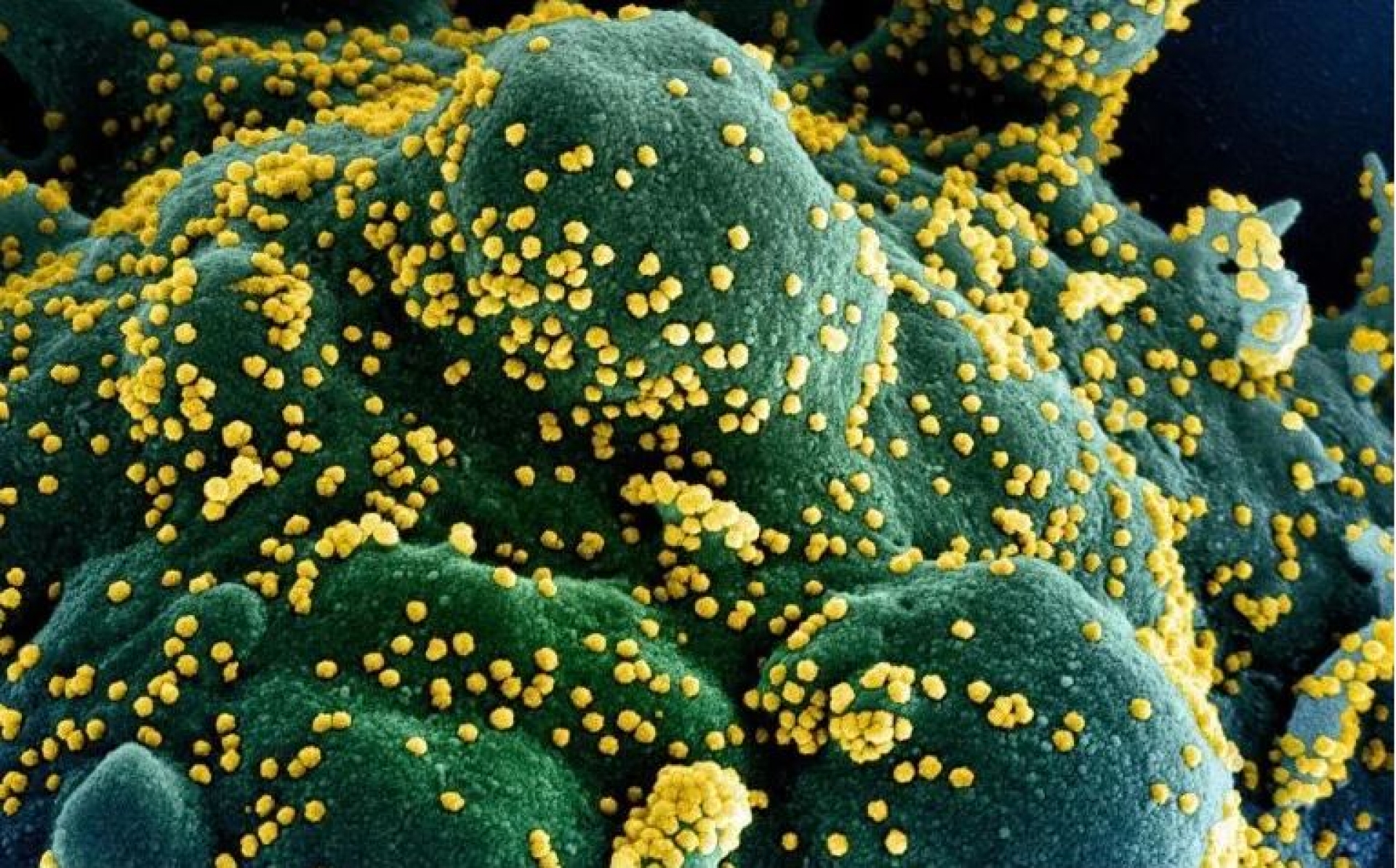 Terapia antiviral muestra resultados positivos en lucha contra COVID-19