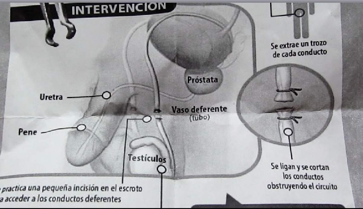 Realizarán jornadas gratuitas de vasectomía sin bisturí en la zona sur