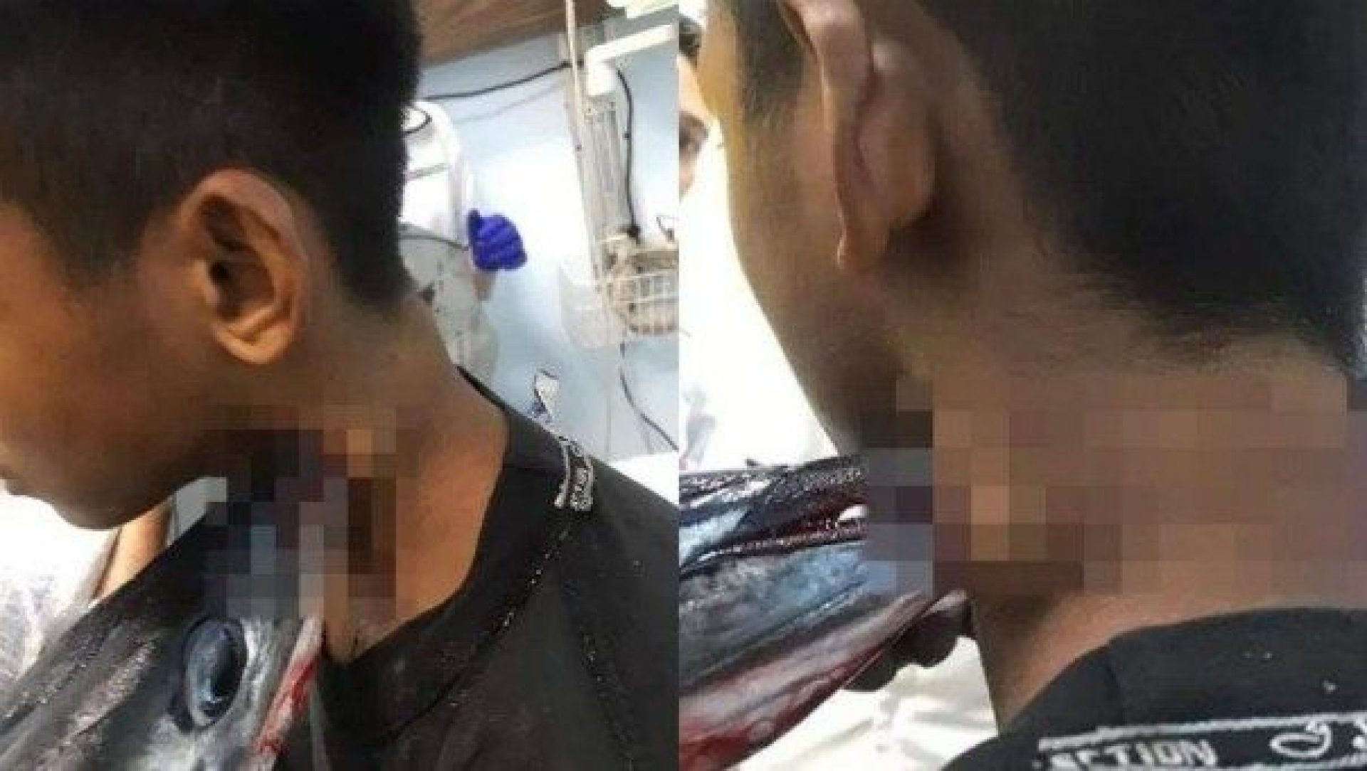 Este pez espada atravesó el cuello de un joven en Indonesia y llegó hasta su cráneo