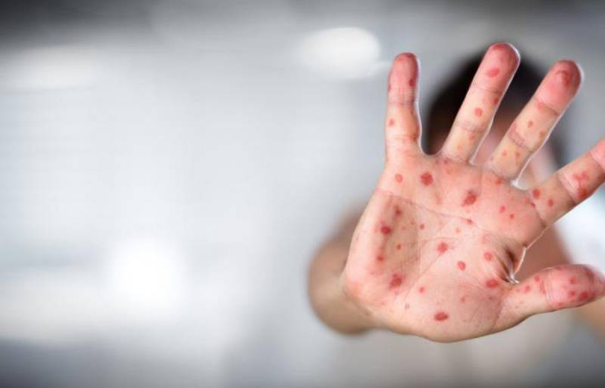 Gripe del tomate: la nueva enfermedad en India que infecta a niños