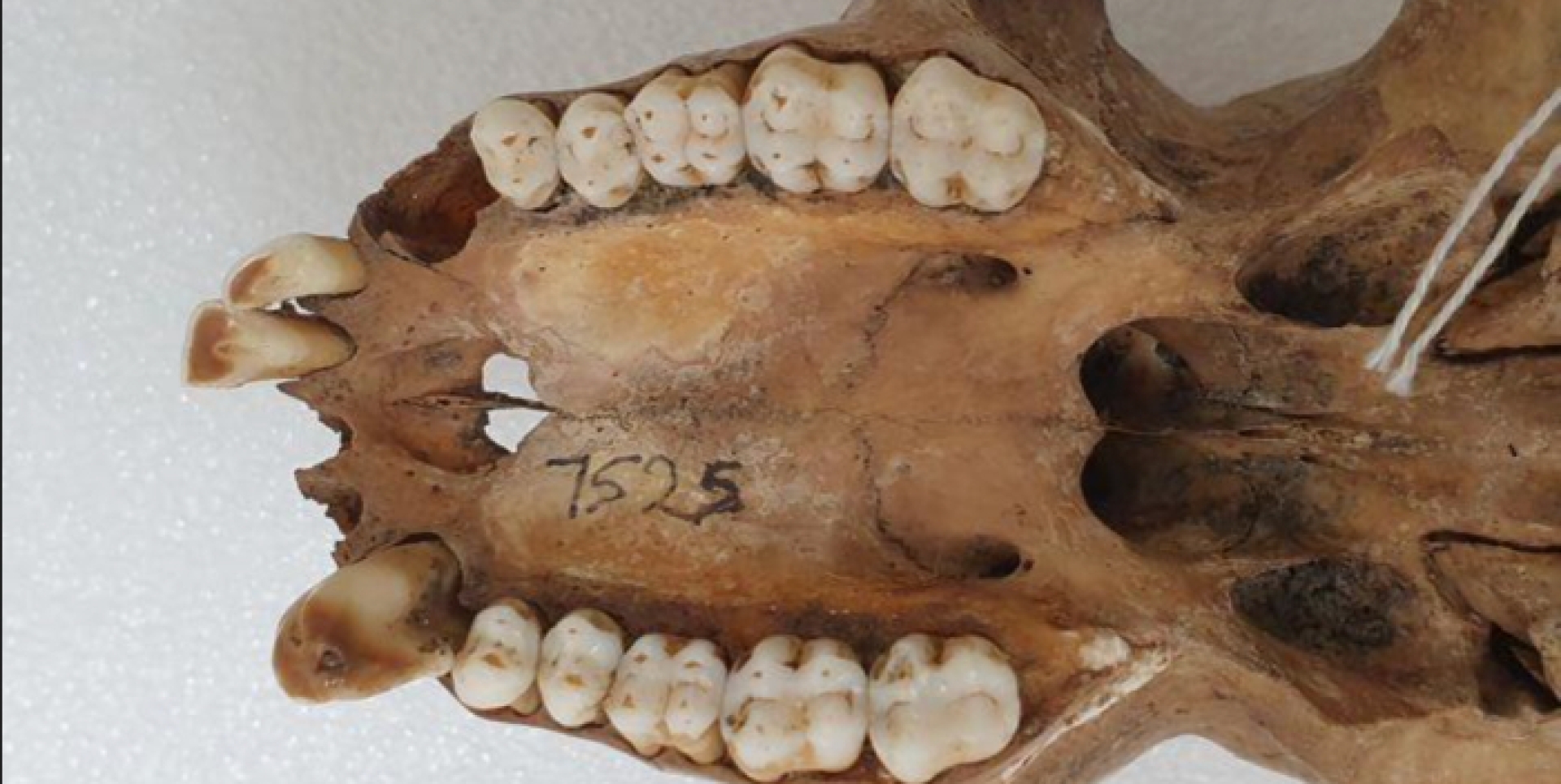 Descubren técnica que aprovecha tejido dental para revelar secretos óseos