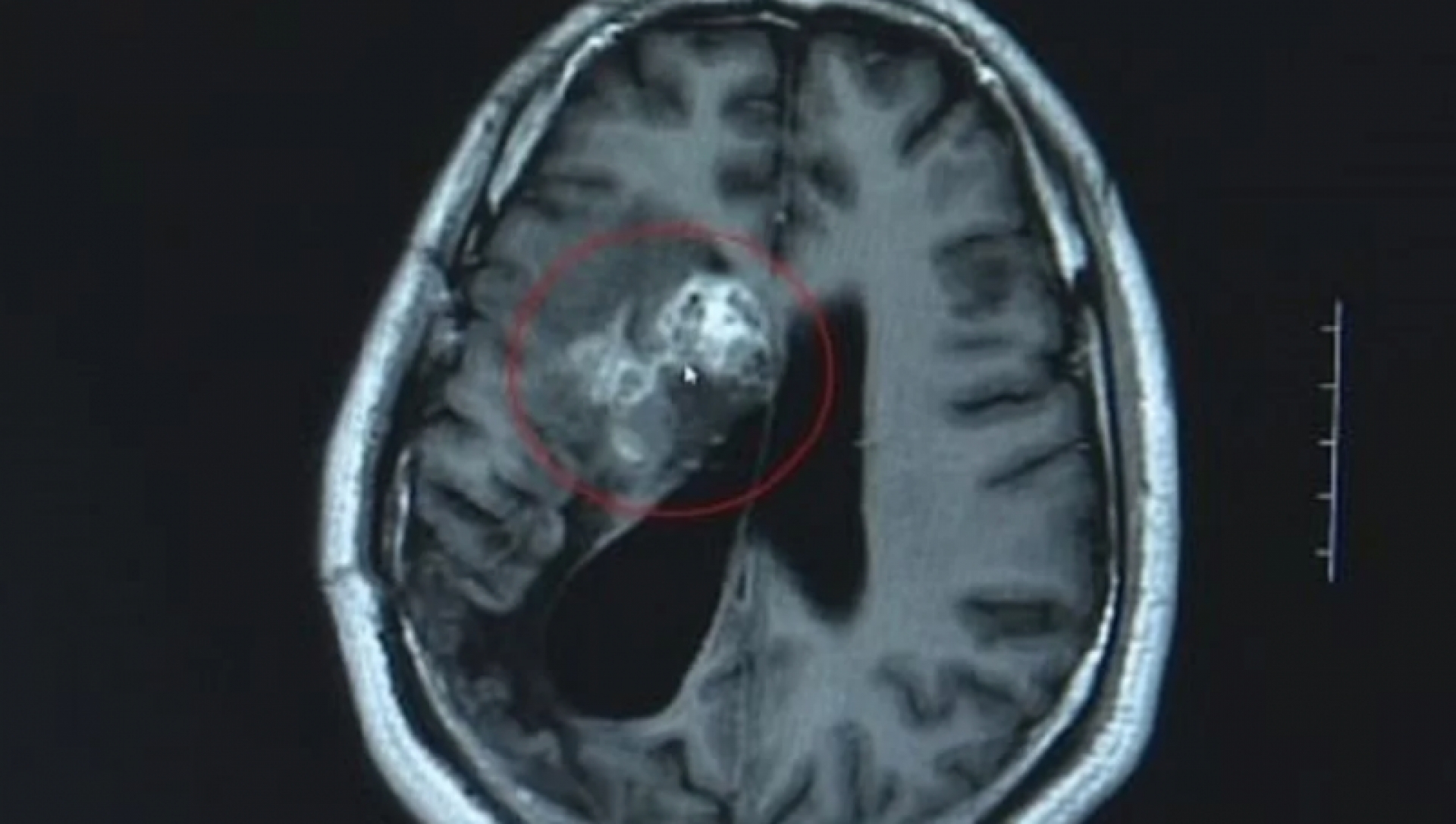 Durante 15 años, un parásito se comió su cerebro