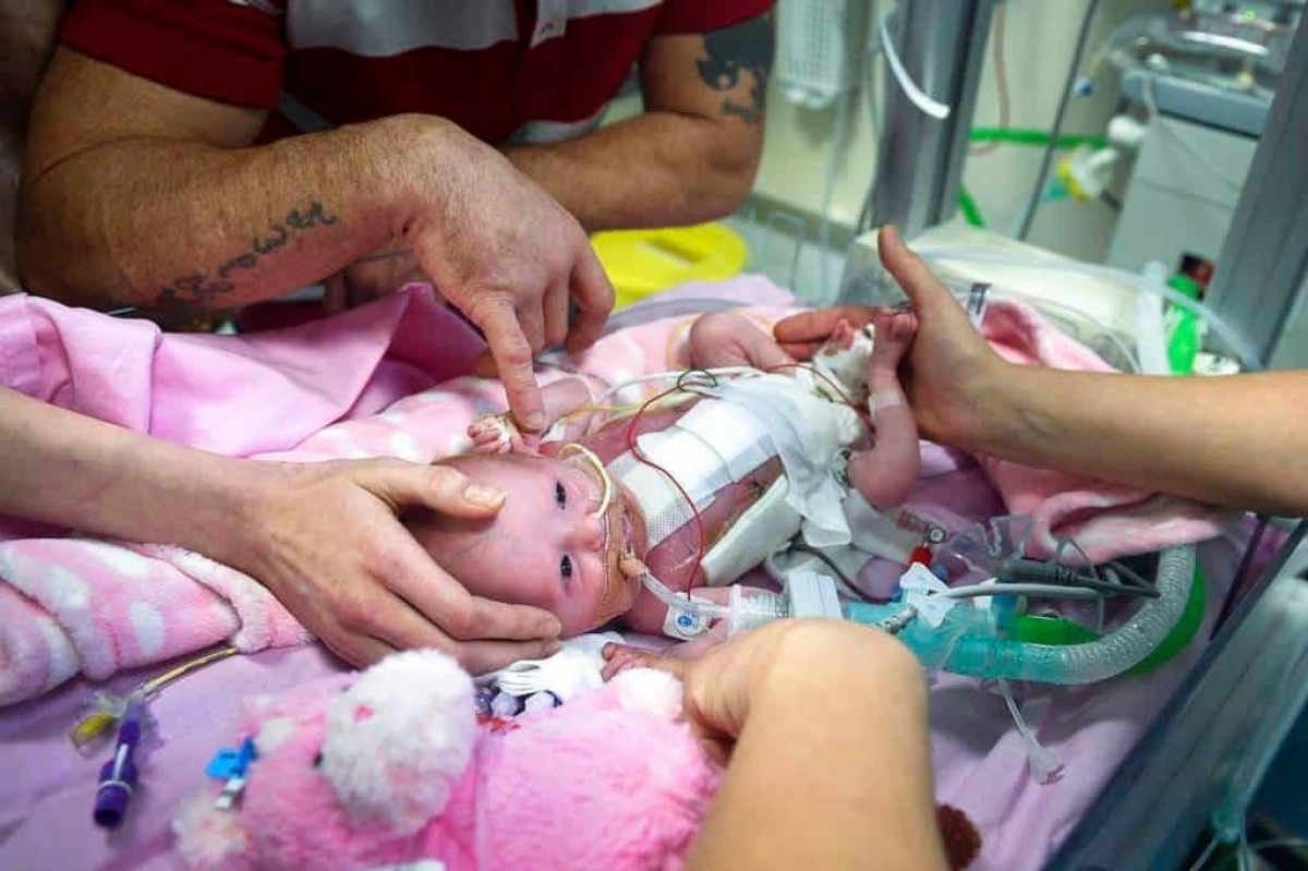 Nace bebé con el corazón de fuera y sobrevive
