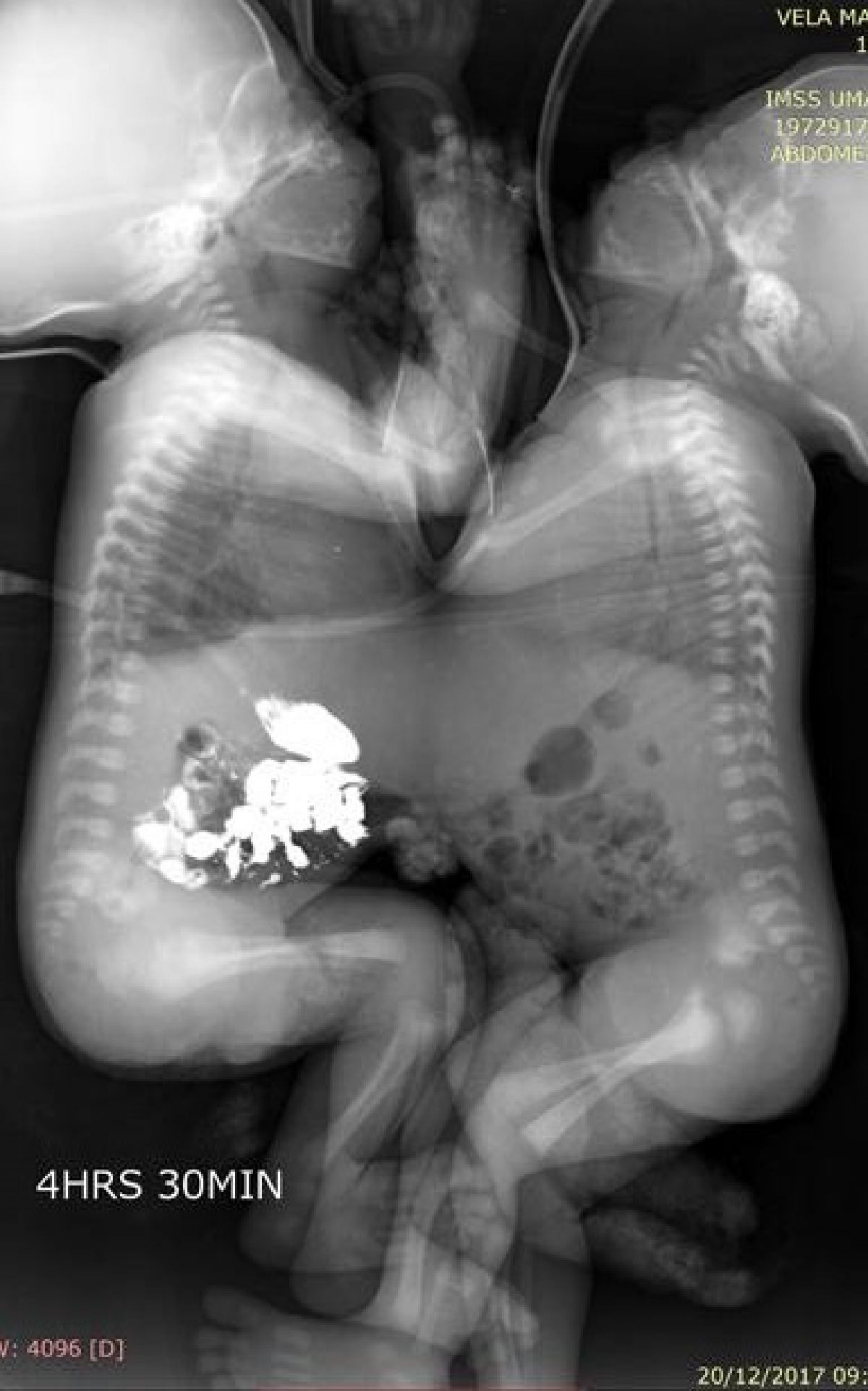 Médicos del IMSS separan con éxito a siameses unidos por tórax y abdomen