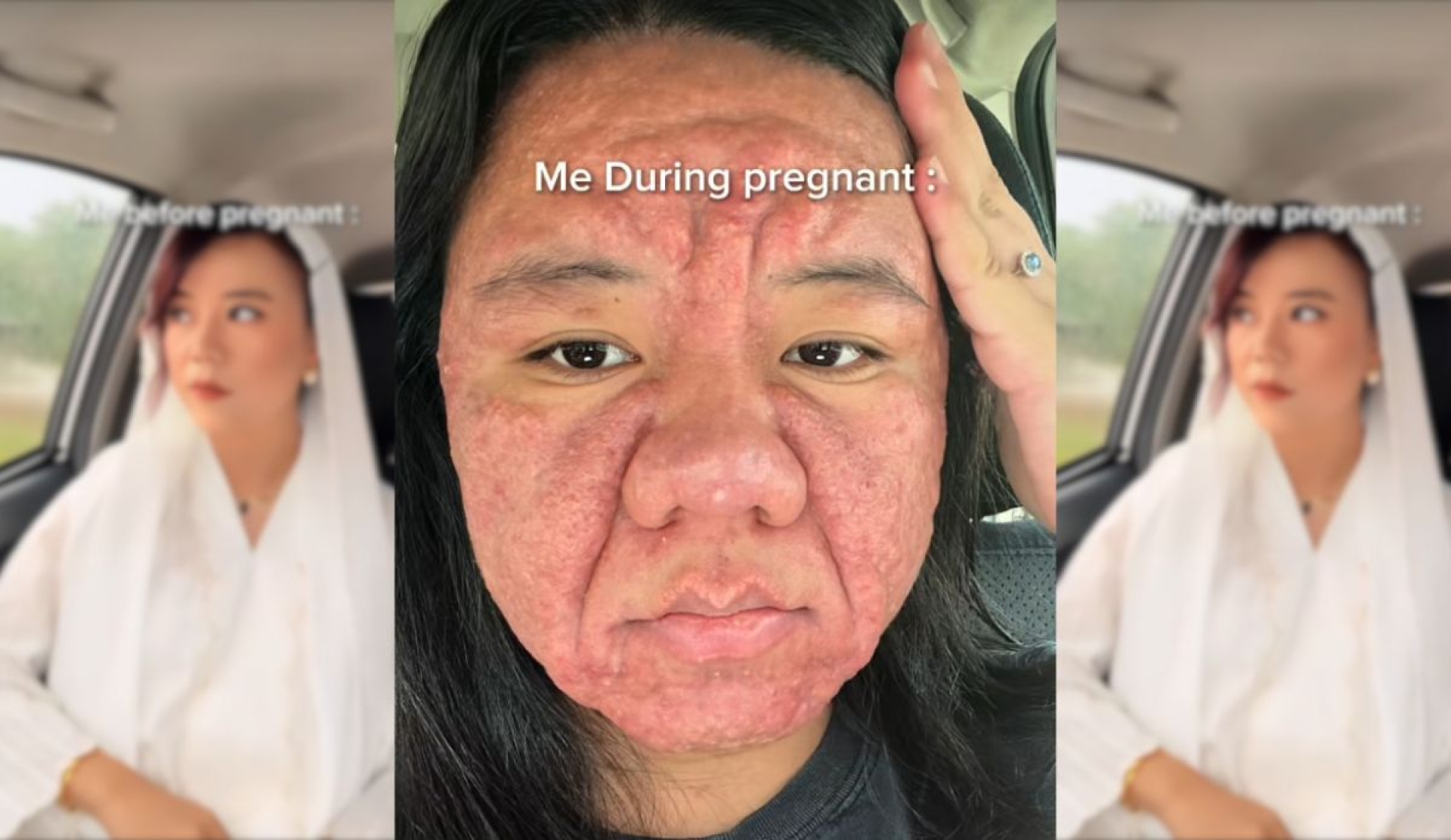 Mujer muestra los duros efectos del embarazo en su piel y se vuelve viral