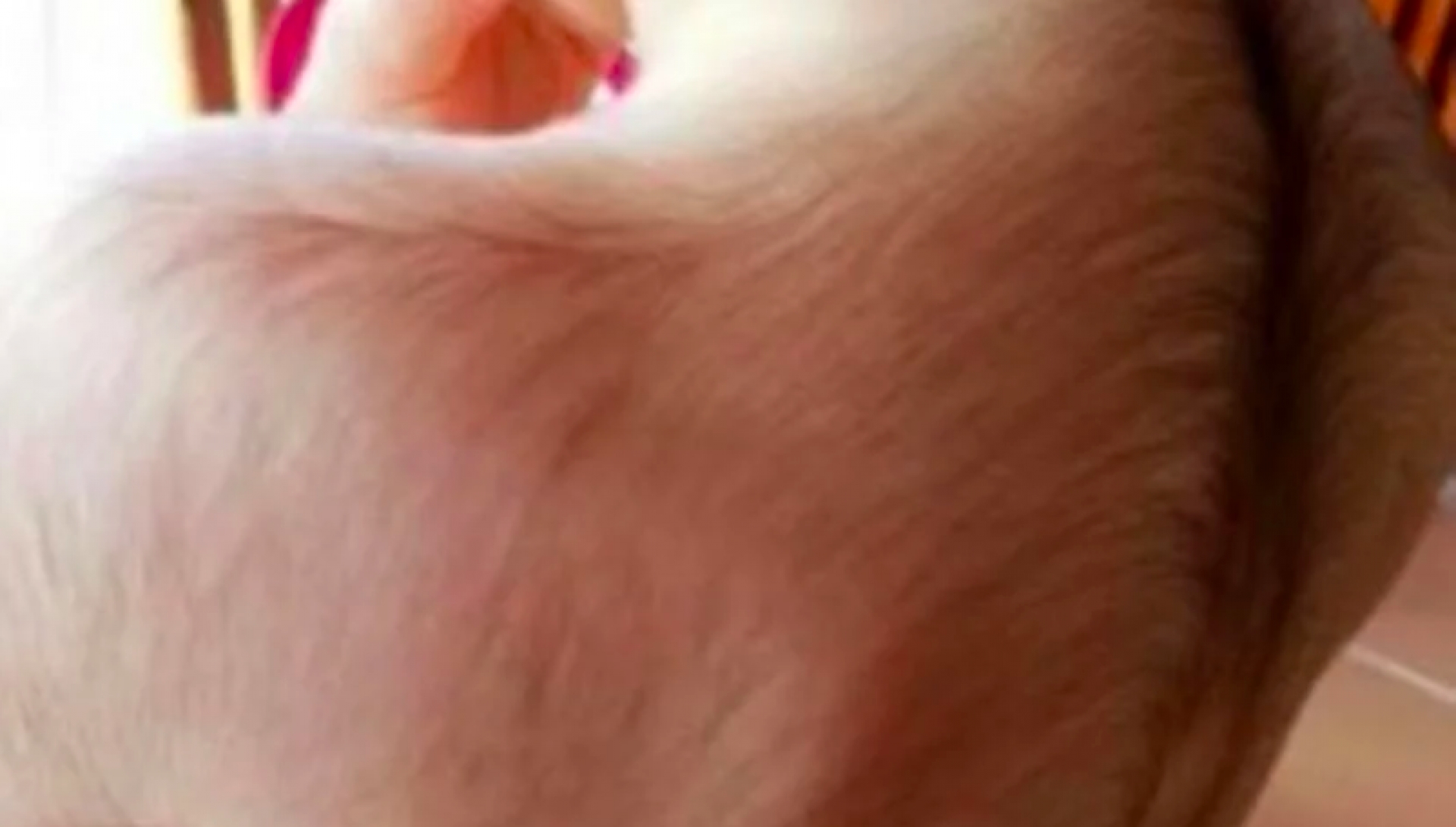 Niño sufre síndrome del 'hombre lobo' debido a un fármaco